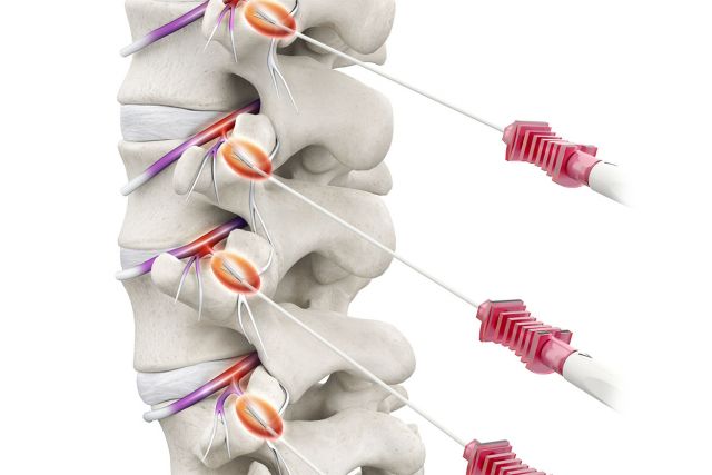 Lumbar Radiofrequency Ablation (RFA)